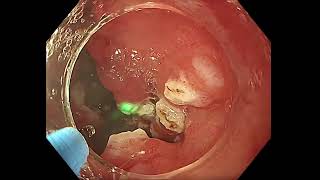 Thulium Fiber Laser for the treatment of GAVE syndrome [upl. by Ocana]