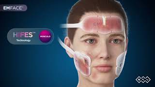 EMFACE lifting facial muscular no quirúrgico [upl. by Thurlough]