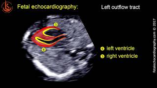 Fetal echocardiography at 1113 weeks Technique of Early Heart Scan [upl. by Ybroc149]