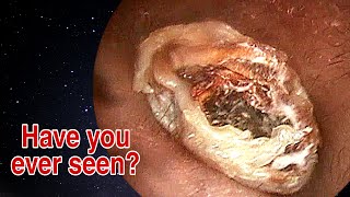 BIGGEST Ear Wax Difficult Removal  EP1  Doctor Anh [upl. by Oiliruam318]