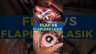 Flap VS Flapless Lasik [upl. by Oiruam23]