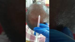 PRP to Treat Hair growth Treatment [upl. by Lrub]