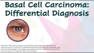 Basal Cell Carcinoma Differential Diagnosis [upl. by Ayotak]