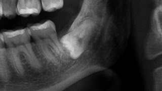 Pourquoi et quand extraire les dents de sagesse [upl. by Haibot]