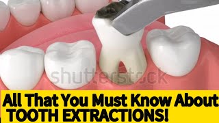 HOW TO EXTRACT A TOOTH  AN EASY CONSCISE GUIDE UK dentist USADENTAL [upl. by Fitzgerald]