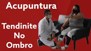 Acupuntura para Tendinite no Ombro [upl. by Procto]