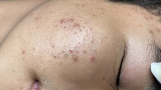 ACNE TREATMENT VU QUYNH MI  Blackheads On Boy Face 2024FULL [upl. by Wes485]