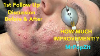 Severe Acne Follow up How did he do One round of extractions done [upl. by Lotty]