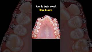 Braces for crowded teeth upper braces orthodontist dentistry dentist [upl. by Stubbs877]