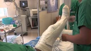 Attelle plâtrée pour une fracture du tibia cruropédieuse [upl. by Filberto]