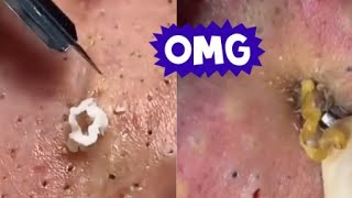 Top Acne Scar Treatments Proven Methods to Clear Your Skin Fast [upl. by Zurheide]