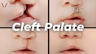 Why Cleft Palates Occur A Scientific Explanation [upl. by Gratiana]