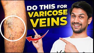 VARICOSE VEINS explained under 10 minutes  Saurabh Bothra Yoga [upl. by Christiano]