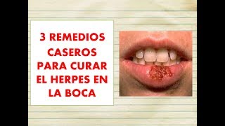 3 REMEDIOS CASEROS para CURAR el HERPES en la BOCA 👄 3 remedios caseros para el FUEGO en los LABIOS [upl. by Eiramyllek]