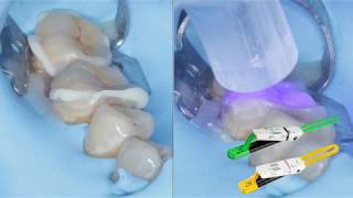 Cements options in Prosthodontics amp concept of Tack Cure [upl. by Seibold]