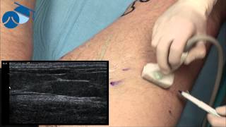 Marking hidden varicose veins for ultrasound guided phlebectomies [upl. by Ellenahs]