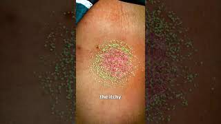 Ringworm 🪱😱 Explained [upl. by Salvay]