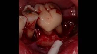 Periodontal Regenerative Therapy on Lower premolar and molarCase 4 [upl. by Ecirp98]