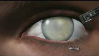 Medical Breakthrough Restoring Sight to the Blind [upl. by Barbaresi745]