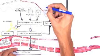 Burns DETAILED Overview  Types Pathophysiology TBSA [upl. by Yemrots]