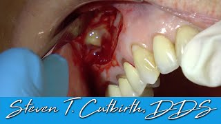 Apicoectomy with Bone Graft and Membrane  with Steven T Cutbirth DDS [upl. by Origra]