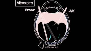 Vitreous 3 Vitrectomy Surgery [upl. by Odraleba]