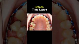 Braces time lapse Before and after transform braces orthodontist bracesoff dentist [upl. by Filbert796]