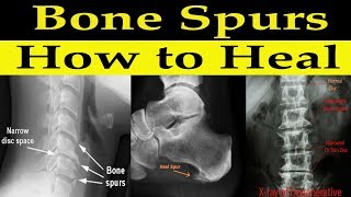 How to Heal Bone Spurs Naturally  Dr Alan Mandell DC [upl. by Timoteo]