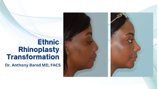 Ethnic Rhinoplasty with dorsal augmentation amp tip graft  Anthony Bared MD FACS  Miami FL [upl. by Hal280]