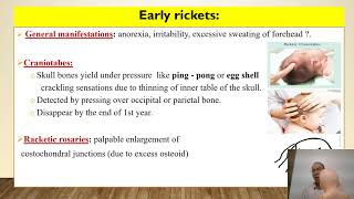 Rickets in children [upl. by Vernice]