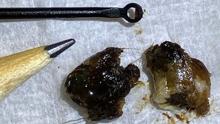 45  Huge Ear Wax Plugs Extracted with Jobson Horne using the WAXscope®️ [upl. by Korney542]