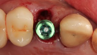 Immediate implant placement with CT graft in buccal pouch [upl. by Aeduj]