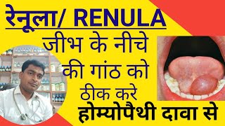 Ranula ll causes of renula symptoms prevention and its homoepathic medicine for renula [upl. by Atilegna782]