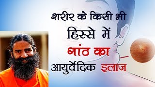 शरीर के किसी भी हिस्से में गांठ का आयुर्वेदिक इलाज  Swami Ramdev [upl. by Collum]