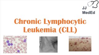 Chronic Lymphocytic Leukemia CLL Symptoms ex Skin Blisters Diagnosis and Treatment Vit D [upl. by Crichton193]