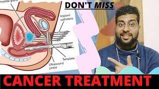 Brachytherapy Explained in Hindi  ब्रैकीथेरेपी क्या है और इसे कैसे किया जाता है [upl. by Kenwood610]