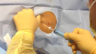 Abdominal Fluid Draining Medical Videos [upl. by Neroled]