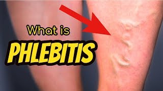 What is Phlebitis [upl. by Eanat]