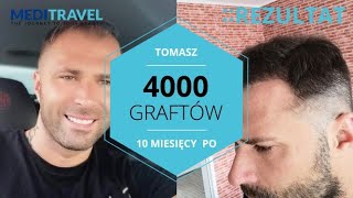 PRZESZCZEP WŁOSÓW  EFEKTY PANA TOMASZA 👱‍♂️  Opinia pacjenta Meditravel 👱‍♂️ [upl. by Braun]