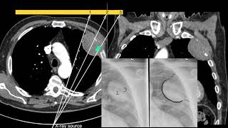 Biopsy Treatment Video  Mediastinal Biopsy  CT Guided Lung Biopsy [upl. by Daniels693]