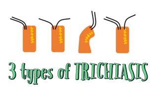 3 types of Trichiasis Distichiasis Entropion and Trichiasis EyeDocSkills [upl. by Eiramanna631]