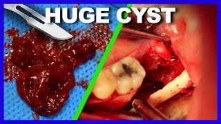 Extracted CYST HUGE [upl. by Schultz]