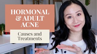 Treating Hormonal Acne  Dermatologist Tips [upl. by Drahsir]