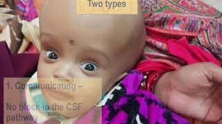 Hydrocephalus in children  Pediatrics [upl. by Yralam447]