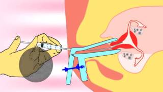 Intrauterine insemination IUI IUTPI the new method of insemination video [upl. by German444]