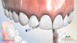 Interproximal Reduction or IPR  Polishing Strip [upl. by Leugimsiul]