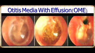 Otitis Media part 4 Otitis media with effusion or serous OM or secretory OM or glue ear [upl. by Nauqit81]