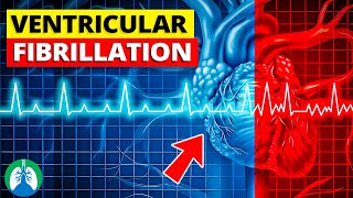 Ventricular Fibrillation Vfib  Medical Explainer Video [upl. by Ardnaxila]