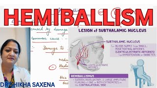 Hemiballism Basal Ganglia disease lesion of subthalamic nuclei [upl. by Charteris162]