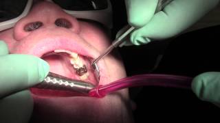 Canker sore treatment and relief at Sana Dental in Edmonton [upl. by Yltneb]